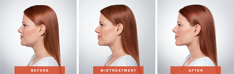 Adra's Kybella procedure before, during, and after photos